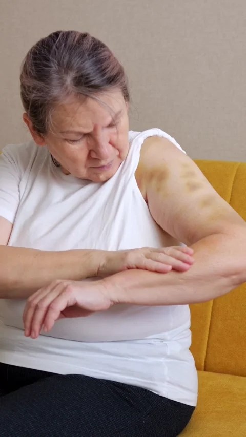Bruised upper arm gets careful attention as woman sits on sofa. She studies Vídeos de archivo 346179840