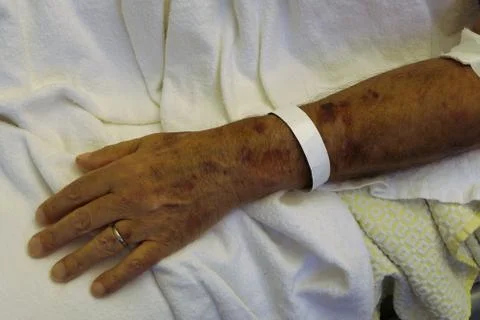 Bruises arm Stock Photos