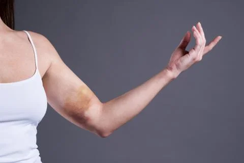 Bruises on the woman's hands, arms with extensive hematoma Stock Photos