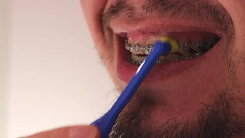 Brush teeth with braces the right way using a special rubber toothbrush Stock Footage 263133555