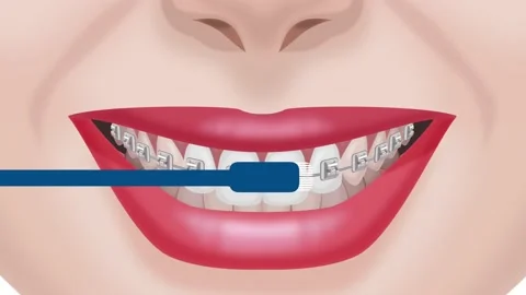 Brushing braces and teeth with a toothbrush Stock Footage 151020645