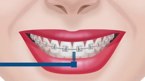 Brushing teeth and braces with a brush Stock Footage 151020646