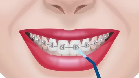 Brushing teeth and braces with an irrigator Stock Footage 151020653