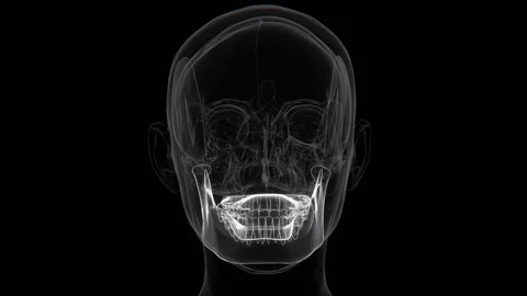 Bruxism is a condition characterized by involuntary teeth grinding or jaw Stock Footage 342303211