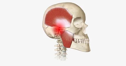 Bruxism is a disorder characterized by abnormal tooth wear due to grinding an Stock Illustration