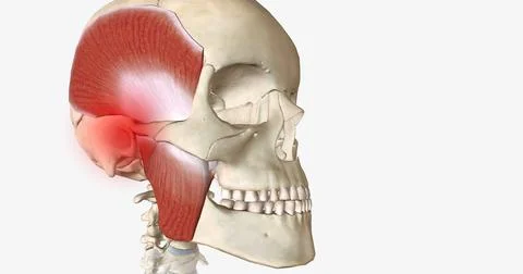 Bruxism is a disorder characterized by abnormal tooth wear due to grinding an Stock Illustration