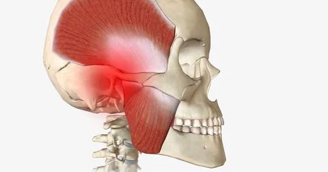 Bruxism is a disorder characterized by abnormal tooth wear due to grinding an Stock Illustration