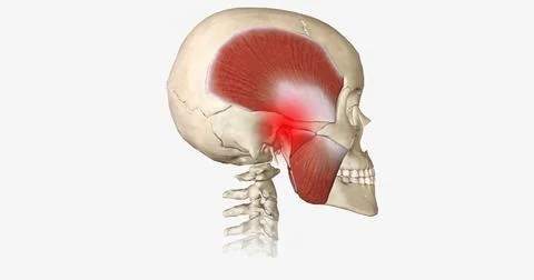 Bruxism is a disorder characterized by abnormal tooth wear due to grinding an Stock Illustration