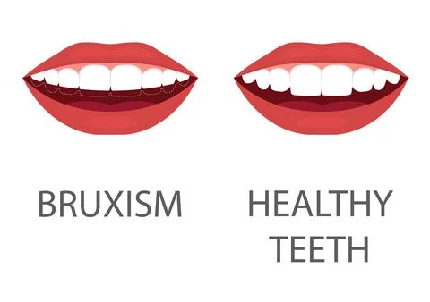 Bruxism Stock Illustration