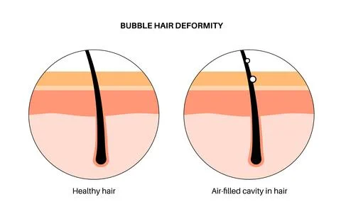 Bubble hair deformity 스톡 일러스트