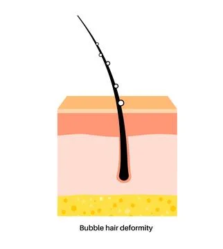Bubble hair deformity 스톡 일러스트