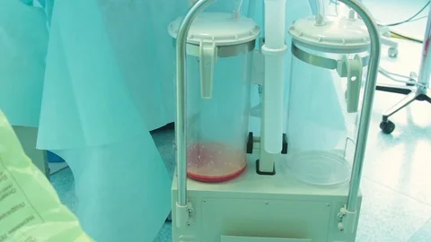 Bulb suction fat during liposuction 스톡 동영상 70003351