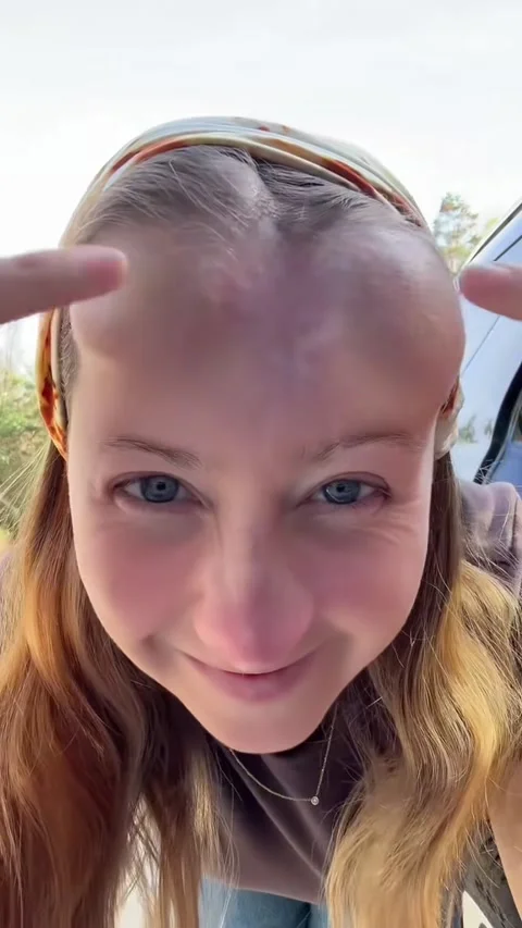 Bulbous Tissue Expanders Help Scars Heal, Warren, Pennsylvania, USA - 02 Oct 202 Stock Footage 320743385