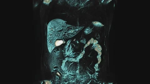 Bulk multicolored CT scan of the abdomen. Computed tomography of the Stock Footage 170488389