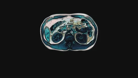 Bulk multicolored CT scan of the abdomen. Computed tomography of the Stock Footage 170488624