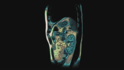 Bulk multicolored CT scan of the abdomen. Computed tomography of the Stock-Footage 171522939