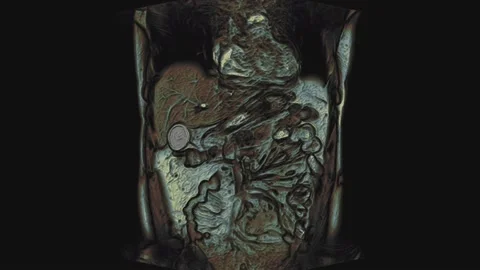 Bulk multicolored CT scan of the abdomen. Computed tomography of the Stock-Footage 189886557