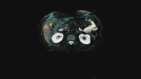 Bulk multicolored CT scan of the abdomen. Computed tomography of the Stock-Footage 195092892