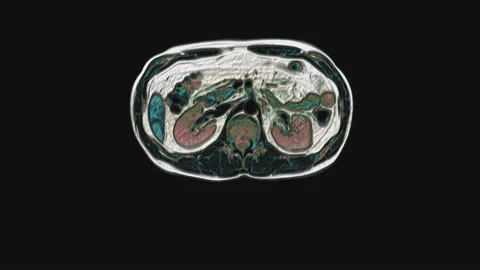 Bulk multicolored CT scan of the abdomen. Computed tomography of the Stock Footage 197382906
