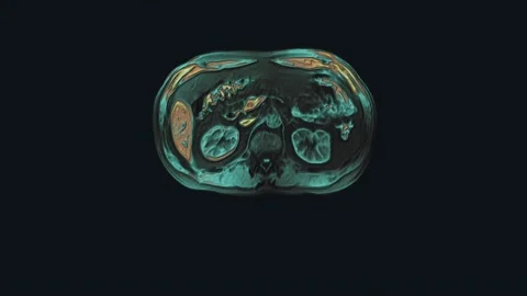 Bulk multicolored CT scan of the abdomen. Computed tomography of the Stock Footage 197692919