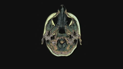 Bulk multicolored MRI brain, head scans and tumor detection. Diagnostic medical Stock Footage 132704065