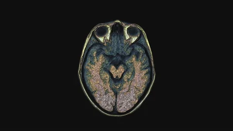 Bulk multicolored MRI brain, head scans and tumor detection. Diagnostic medical Stock Footage 134159591