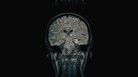 Bulk multicolored MRI brain, head scans and tumor detection. Diagnostic medical Stock Footage 134597514