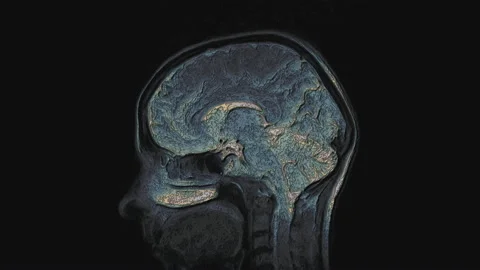 Bulk multicolored MRI brain, head scans and tumor detection. Diagnostic medical Stock Footage 136412681