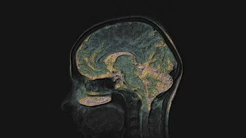 Bulk multicolored MRI brain, head scans and tumor detection. Diagnostic medical Stock Footage 137660533