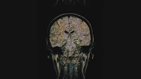 Bulk multicolored MRI brain, head scans and tumor detection. Diagnostic medical Stock Footage 138004111