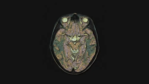 Bulk multicolored MRI brain, head scans and tumor detection. Diagnostic medical Stock Footage 138562110