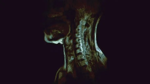 Bulk multicolored MRI of the cervical spine, detection of protrusions and Stock Footage 132172313