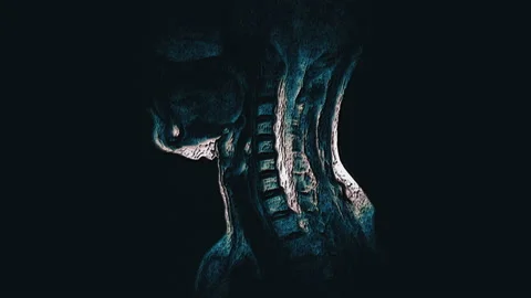 Bulk multicolored MRI of the cervical spine, detection of protrusions and Stock Footage 133242585
