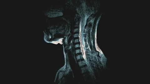 Bulk multicolored MRI of the cervical spine, detection of protrusions and Stock Footage 134443173