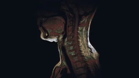 Bulk multicolored MRI of the cervical spine, detection of protrusions and Stock Footage 136574228