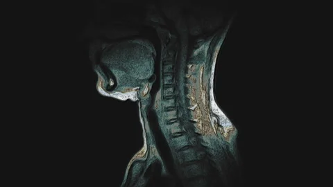 Bulk multicolored MRI of the cervical spine, detection of protrusions and Stock Footage 136725295