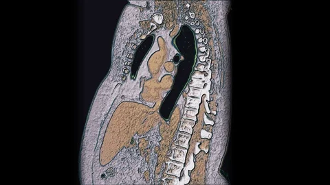 Bulk multicolored MRI of the lungs and bronchi, diagnosis of viral or covid-19 Stock Footage 129839926