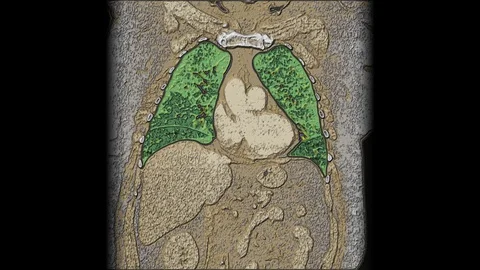 Bulk multicolored MRI of the lungs and bronchi, diagnosis of viral or covid-19 Video stock 130141446
