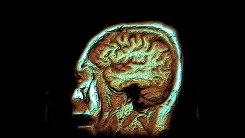 Bulk multicolored MRI scans of the brain and head to detect tumors. Diagnostic Stock-Footage 121518321