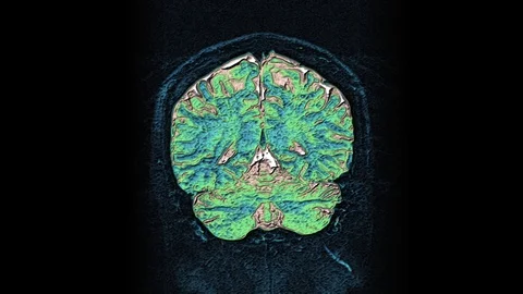 Bulk multicolored MRI scans of the brain and head to detect tumors. Diagnostic Stock-Footage 121518444