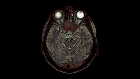 Bulk multicolored MRI scans of the brain and head to detect tumors. Diagnostic Stock-Footage 121804526