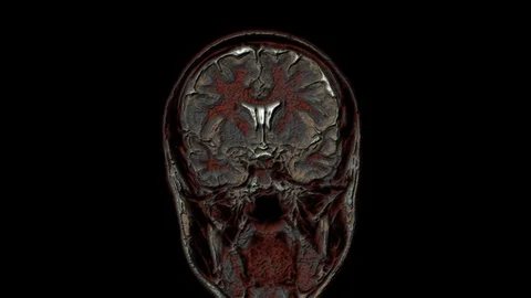 Bulk multicolored MRI scans of the brain and head to detect tumors. Diagnostic Stock-Footage 121804684