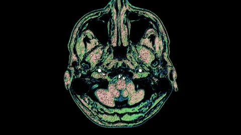 Bulk multicolored MRI scans of the brain and head to detect tumors. Diagnostic Stock-Footage 121804824