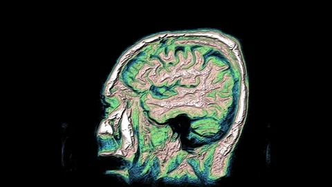 Bulk multicolored MRI scans of the brain and head to detect tumors. Diagnostic Stock-Footage 121806279