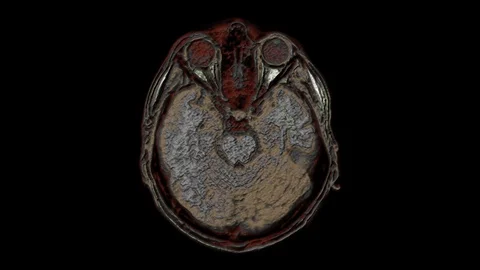 Bulk multicolored MRI scans of the brain and head to detect tumors. Diagnostic Stock-Footage 122073067