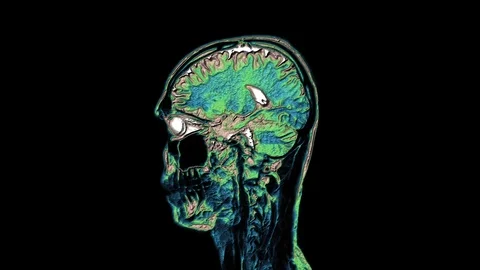 Bulk multicolored MRI scans of the brain and head to detect tumors. Diagnostic Stock-Footage 122073282