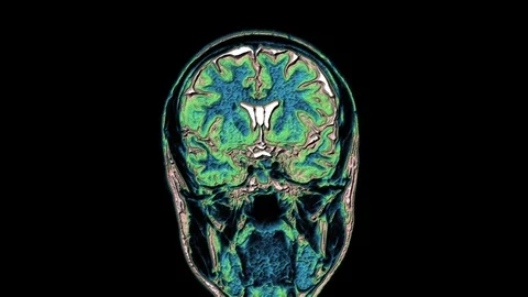Bulk multicolored MRI scans of the brain and head to detect tumors. Diagnostic Stock-Footage 122073352