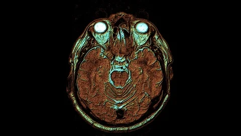 Bulk multicolored MRI scans of the brain and head to detect tumors. Diagnostic Stock-Footage 122073408