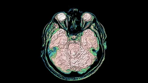 Bulk multicolored MRI scans of the brain and head to detect tumors. Diagnostic Stock-Footage 122749316