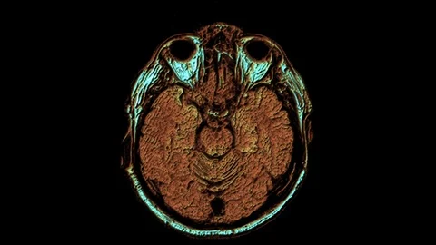 Bulk multicolored MRI scans of the brain and head to detect tumors. Diagnostic Stock Footage 122749549